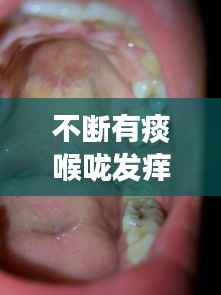 不断有痰喉咙发痒,嗓有痰,还痒痒怎么办