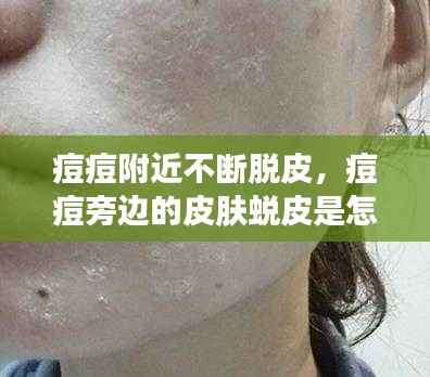 痘痘附近不断脱皮,痘痘旁边的皮肤蜕皮是怎么回事